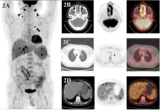 PET/CT scans are ‘critically important’ for patients with NK/T-cell lymphoma